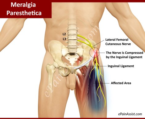 Meralgia-Paresthetica